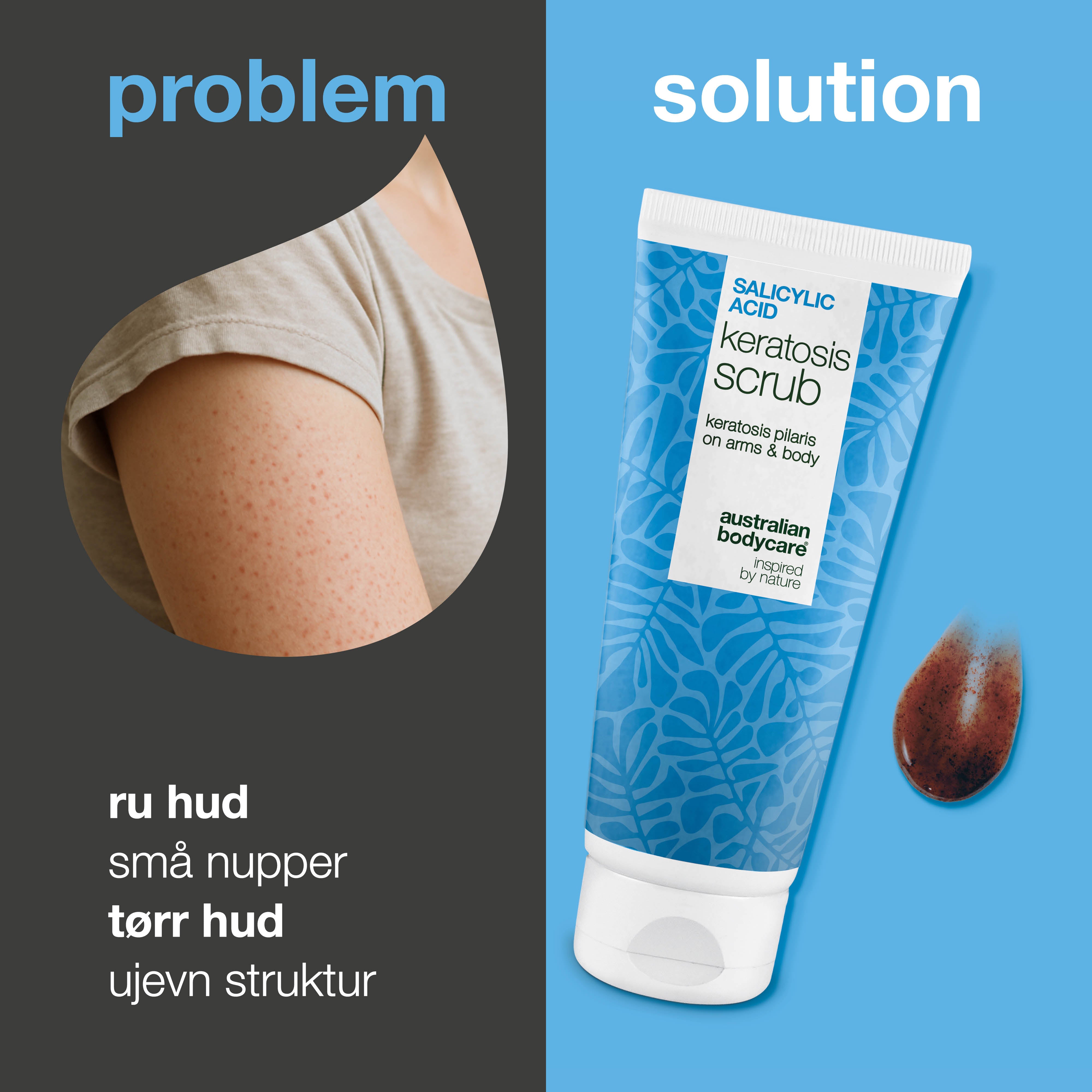 Keratosis Pilaris Body Scrub fjerner døde hudceller og gjør huden mykere. Med salisylsyre, glykolsyre, allantoin og glyserin for jevn og frisk hud.