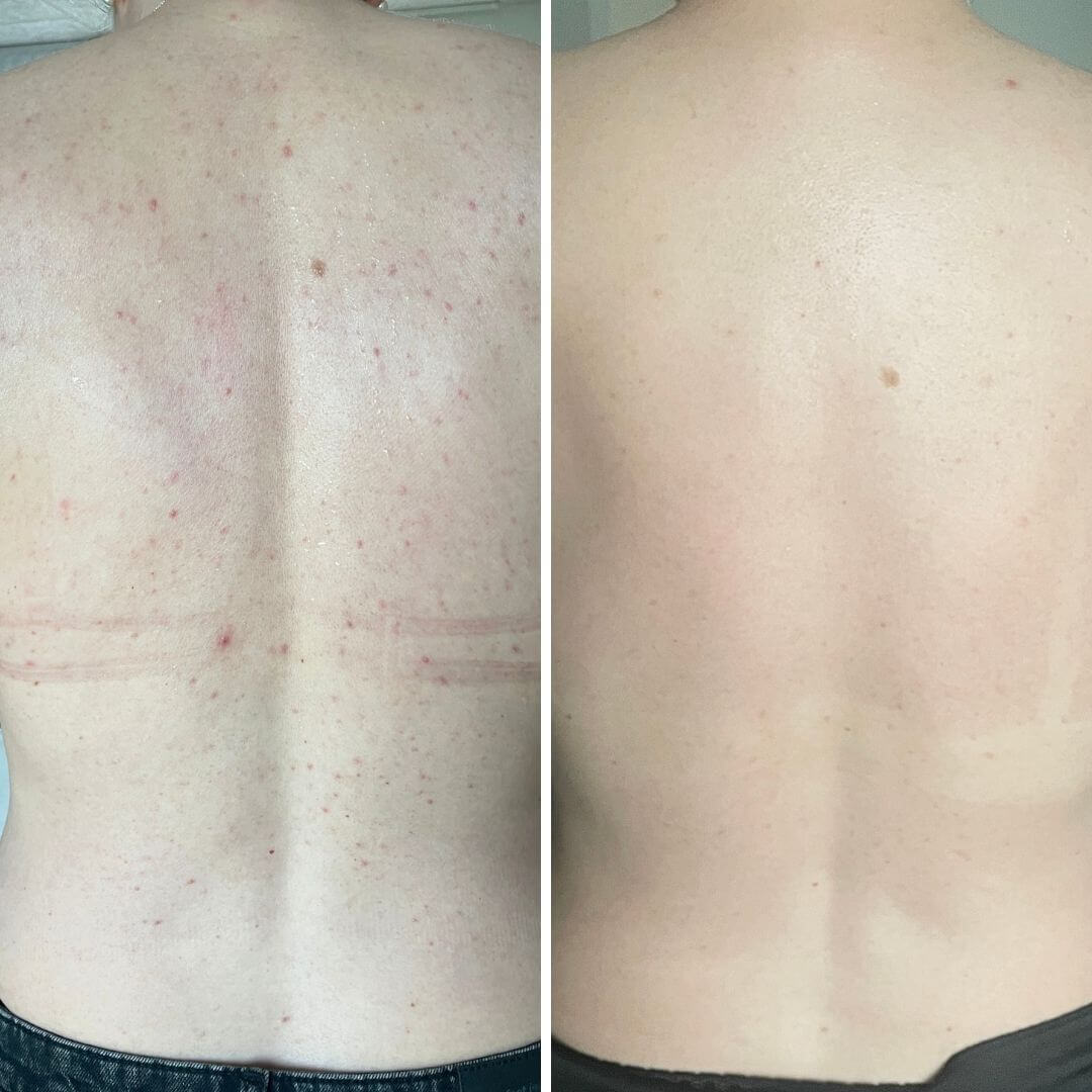 Før- og etterbilde av en rygg med synlige kviser og akne på "før"-bildet, og en klar, jevn rygg uten urenheter etter 4 ukers jevnlig bruk av Australian Bodycare Salisylsyre Body Spray.