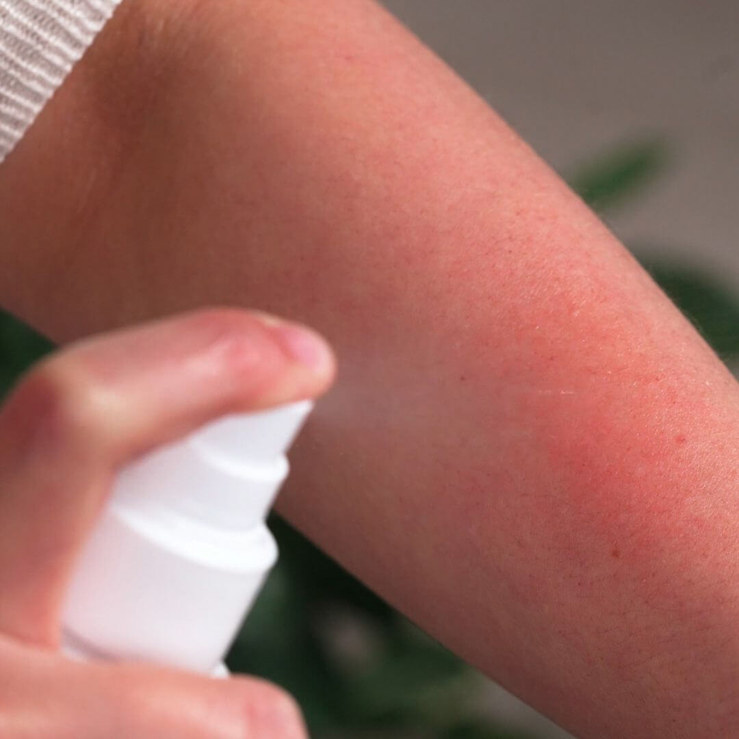 Spray til at lindre ubehag ved hudirritation - Beroligende, lindrende spray til irritert hud
