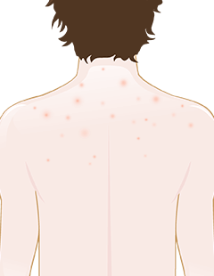  Keratosis Pilaris (kyllinghud)