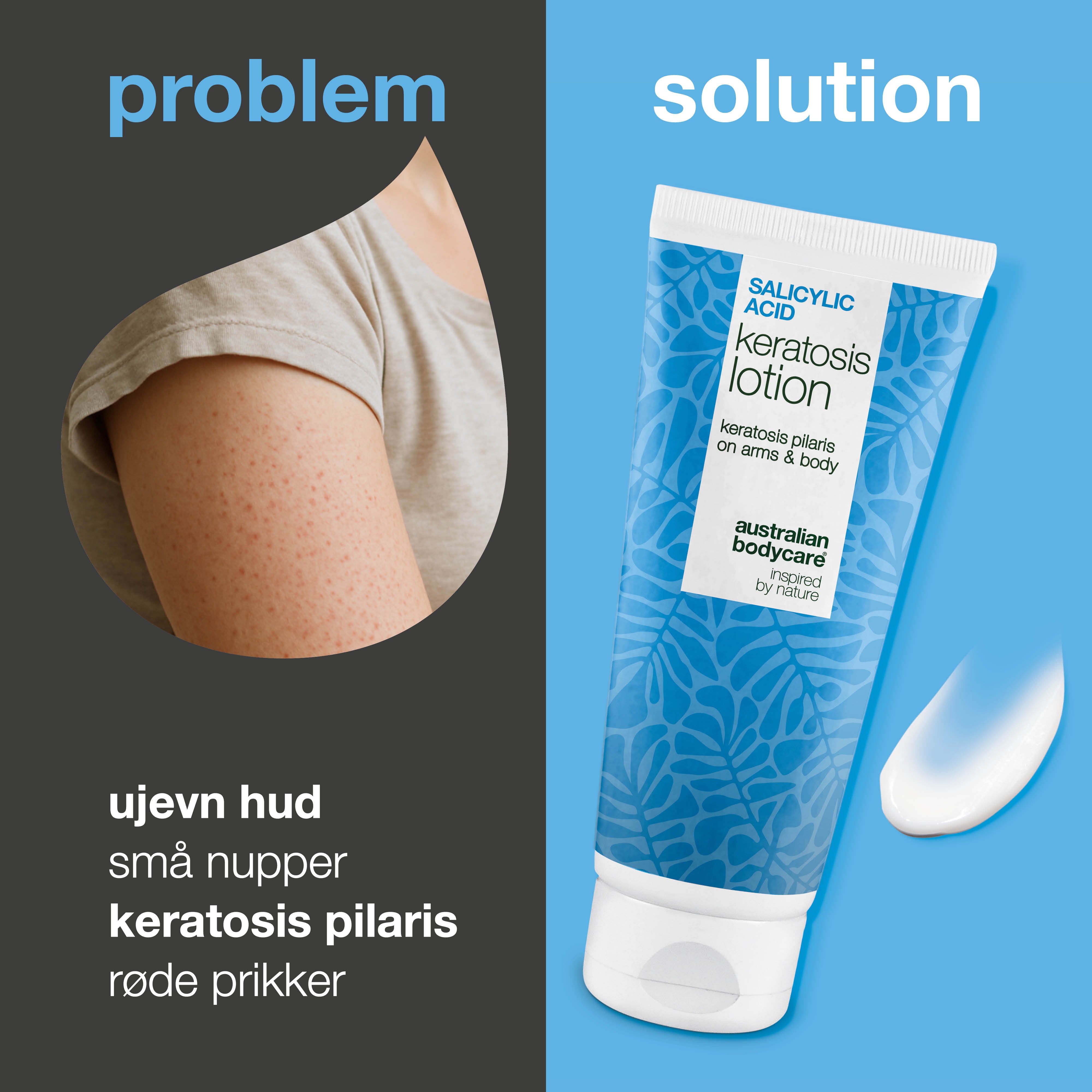 Body lotion for keratosis pilaris og ru, nuppete hud — Body lotion for keratosis pilaris og tørr hud. Inneholder salisylsyre, niacinamid og sink for glattere hud.