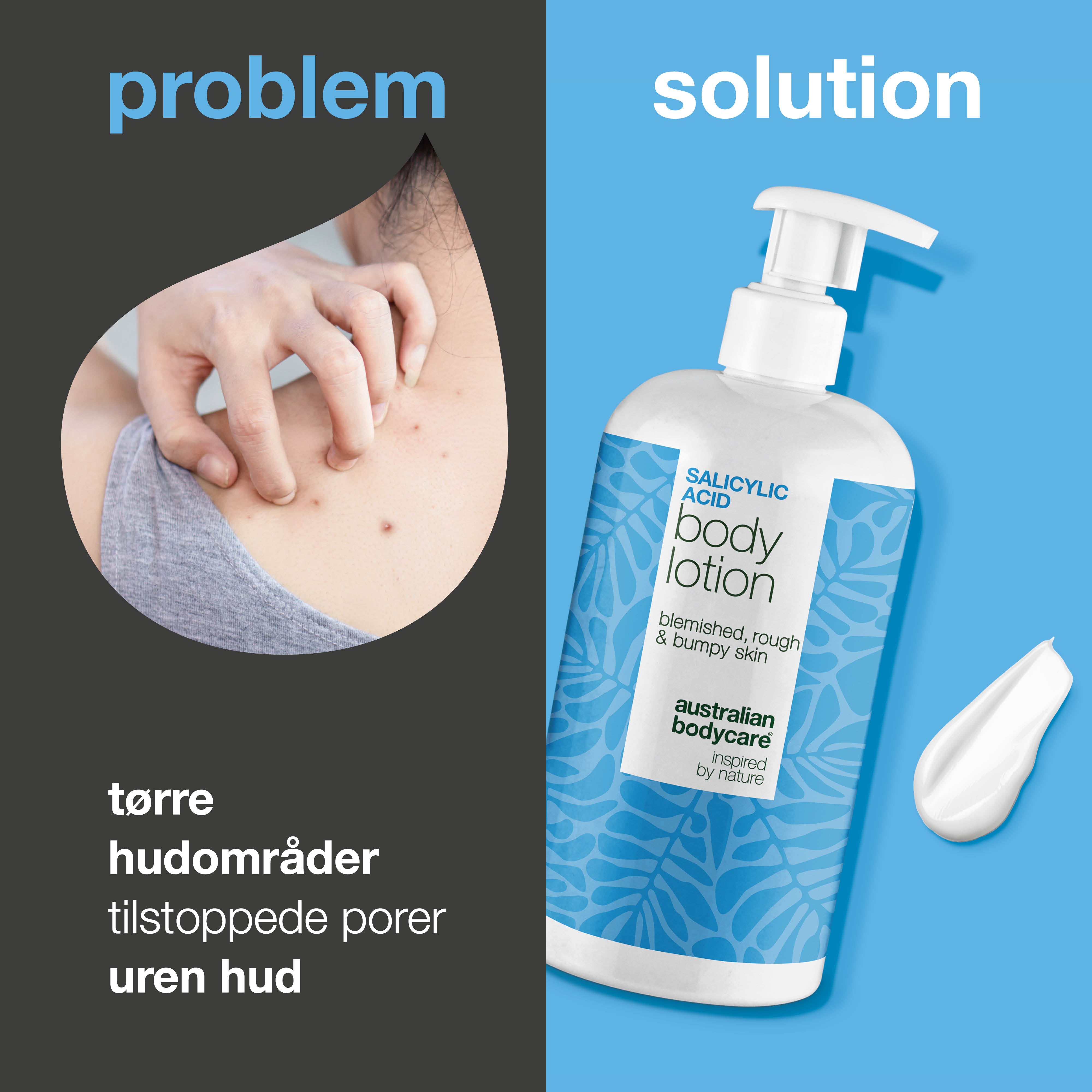 Body Lotion med salisylsyre – for tørr og ujevn hud — Body Lotion med salisylsyre eksfolierer, fukter og hjelper med å mykgjøre tørr og ujevn hud. Perfekt for daglig bruk.