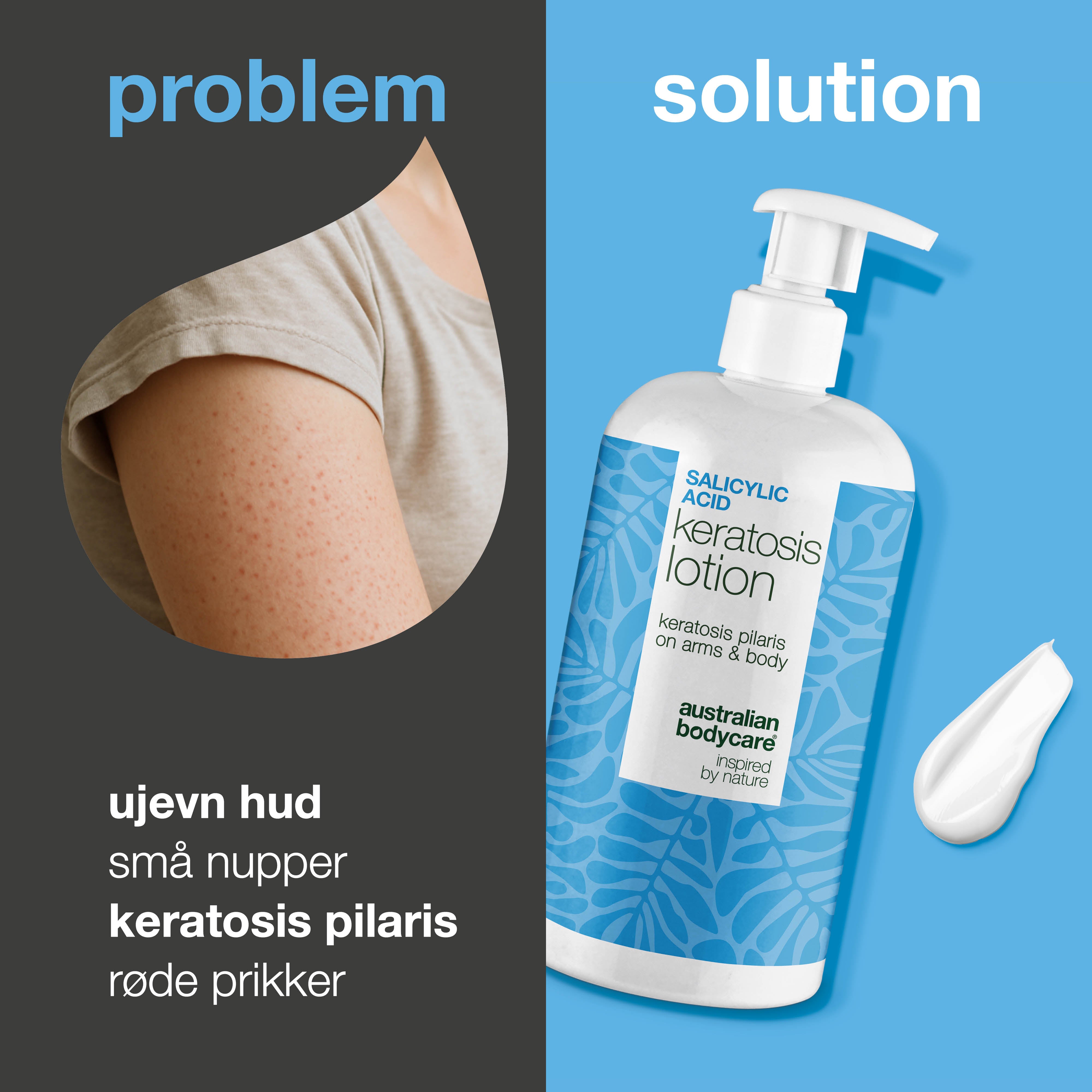 Body lotion for keratosis pilaris og ru, nuppete hud — Body lotion for keratosis pilaris og tørr hud. Inneholder salisylsyre, niacinamid og sink for glattere hud.