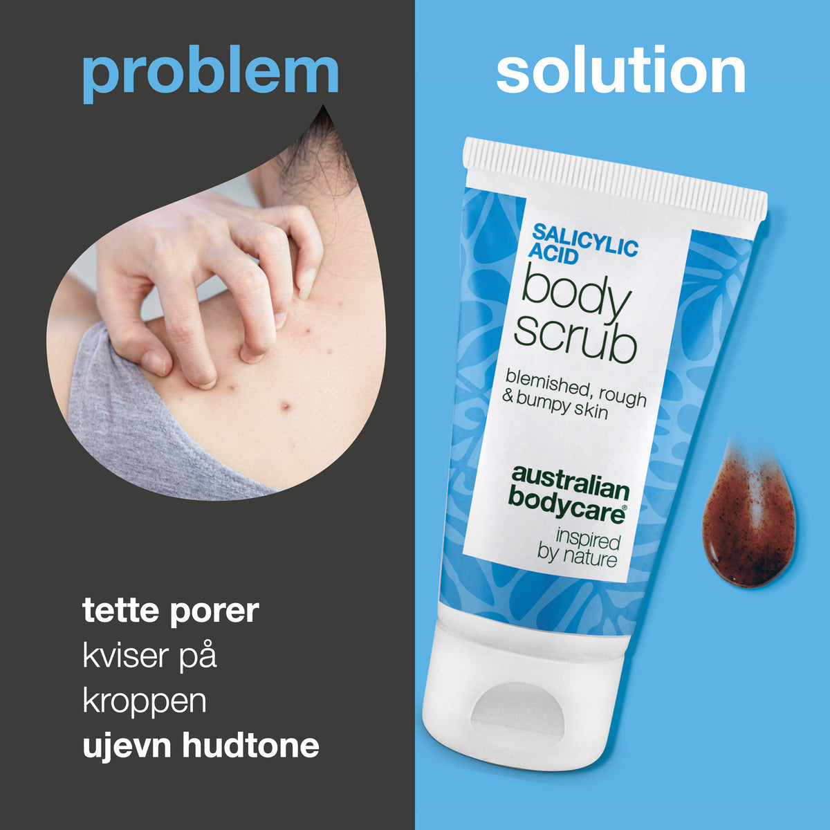 Problem og løsning: kviser på kroppen, tette porer og ujevn hud. Til venstre et nærbilde av en skulder med kviser, til høyre Salicylic Acid Body Scrub fra Australian Bodycare