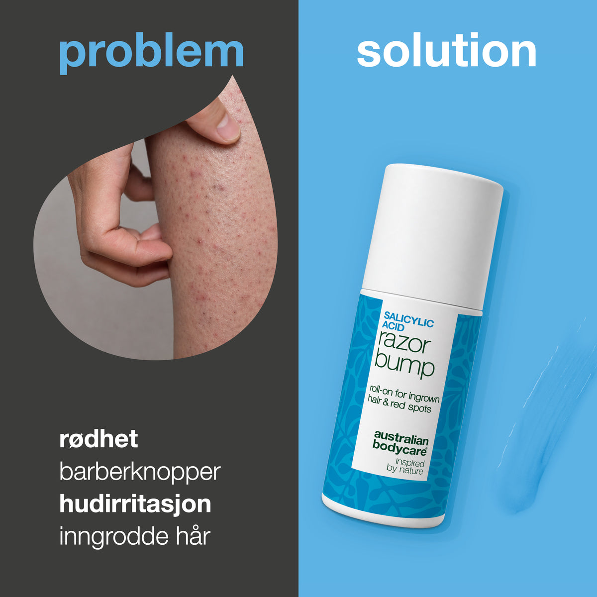 Problem og løsning: rødhet, barberknopper, hudirritasjon og inngrodde hår. Til venstre et nærbilde av en hånd som klyper i et lår med røde knopper, til høyre en Salisylsyre Razor Bump roll-on fra Australian Bodycare.
