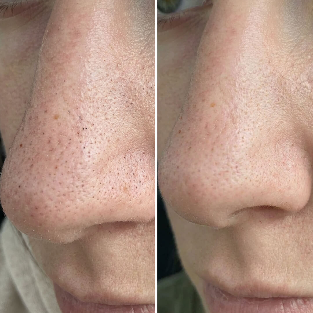 Pakke mot hudormer og tette porer med salisylsyre – dyprensende rutine for glatt og ren hud