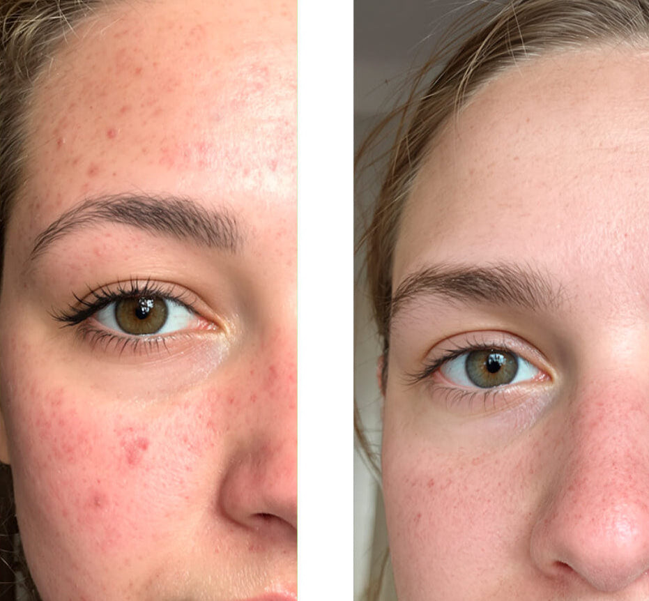 Før/etter-bilde av en kunde som bruker vår 2% Salicylic Acid Face Toner/Peeling/Exfoliant, som viser stor forbedring i huden med færre kviser og urenheter.