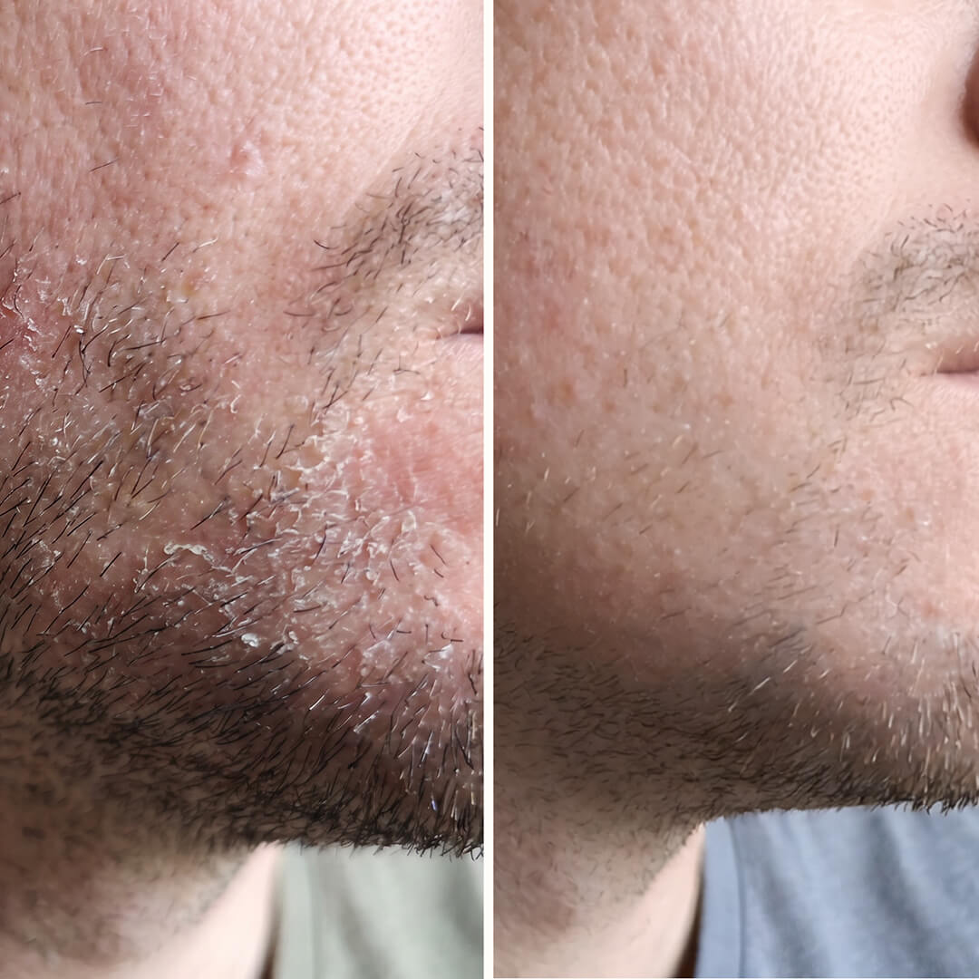 Salisylsyre Serum – Mot flass i ansiktet, skjegg og bryn — Effektivt serum mot flass i ansiktet og skjegget. Salisylsyre fjerner flass og rødhet raskt, slik at huden gjenvinner sin sunne balanse.