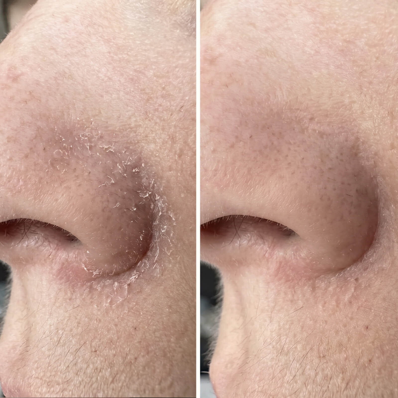 Salisylsyre Serum – Mot flass i ansiktet, skjegg og bryn — Effektivt serum mot flass i ansiktet og skjegget. Salisylsyre fjerner flass og rødhet raskt, slik at huden gjenvinner sin sunne balanse.