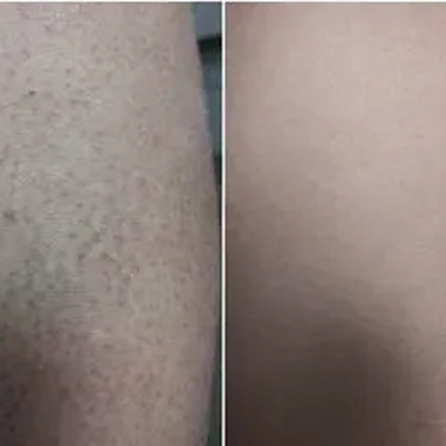 Alenas resultat etter 2 uker med keratosis pilaris-settet