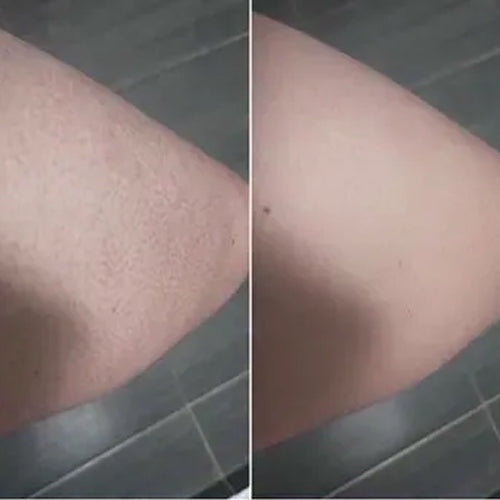 Keratosis pilaris før og etter – Alenas glattere hud etter 2 uker