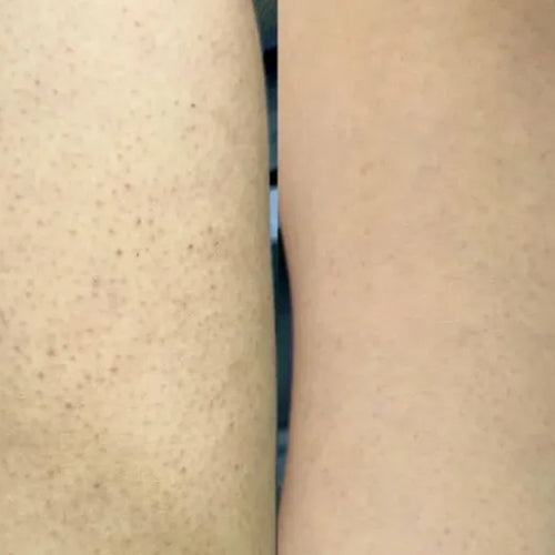 Isabells resultat med keratosis pilaris-settet – færre knopper på lårene