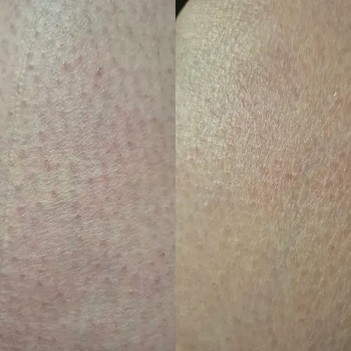 Nærbilde av hud etter keratosis pilaris-behandling – Carolins resultat