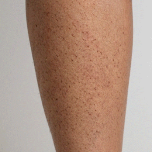 Nærbilde av keratosis pilaris – små ru knopper på armene
