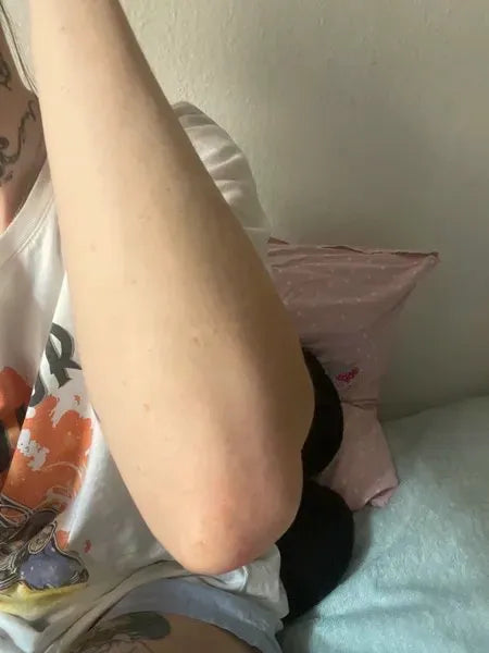 Kunderesultat keratosis pilaris – Lisa A.