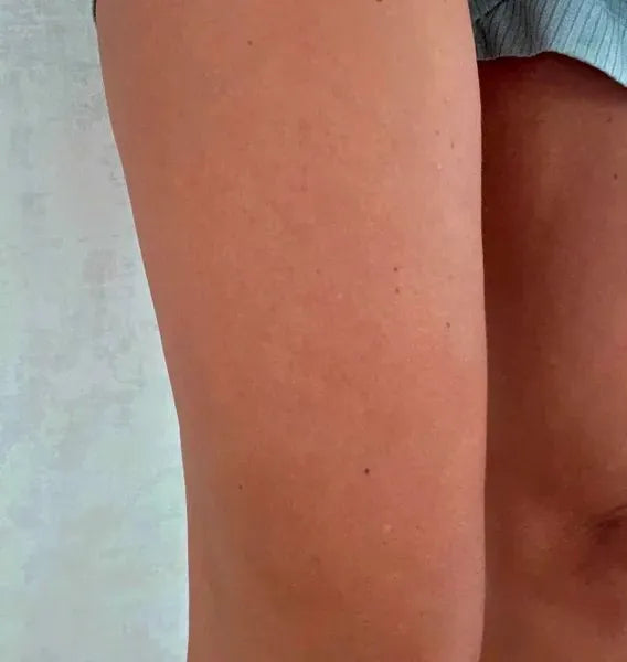 Kunderesultat keratosis pilaris – Sarah S.