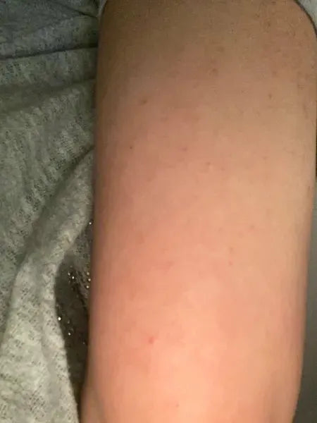 Kunderesultat keratosis pilaris – Shaian H. bruker Australian Bodycare