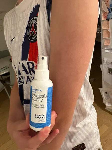 Kunderesultat keratosis pilaris – 70% reduksjon av knopper etter 3 uker
